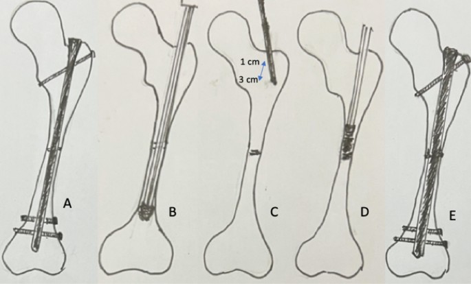 AmaniMed Orthopedic Implant (@amanimed.7) • Instagram photos and videos