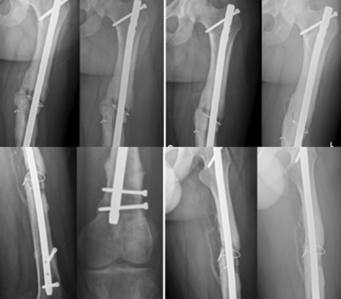 Surgical fixation of ipsilateral femoral neck and shaft fractures: a matter  of debate? in: EFORT Open Reviews Volume 8 Issue 9 (2023)