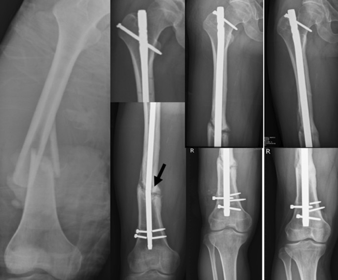 Antegrade Femoral Nail Distal Interlocking Screw Causing Rupture of the  Medial Patellofemoral Ligament and Patellar Instability | MDedge Surgery