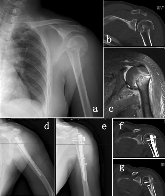 First humerus lengthening osteotomy with a magnet-operated intramedullary  nail in Switzerland – a preliminary case report