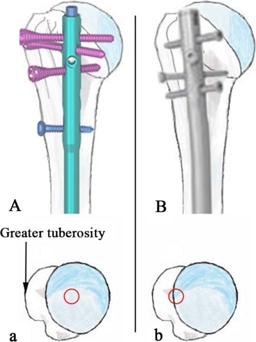 IM Nailing of Humeral Shaft Frx : Wheeless' Textbook of Orthopaedics