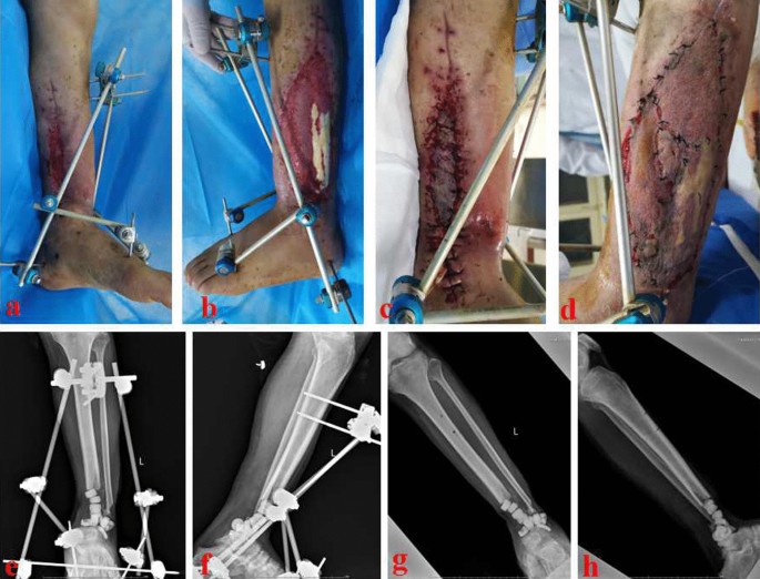 TIBIA BY HYBRID FIXATION