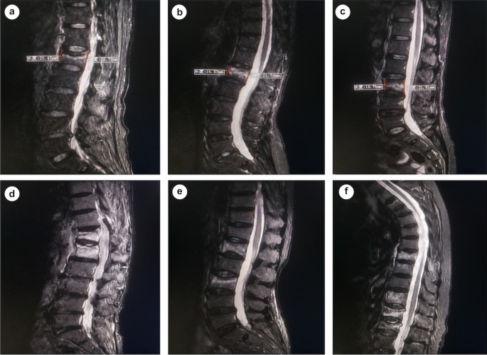 Figure 2 from Vertebral compression fractures in the elderly