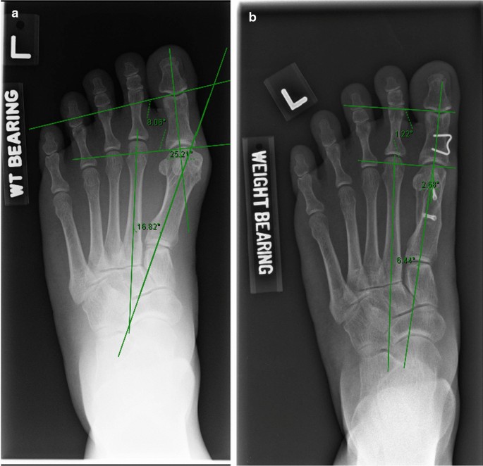 Scarf osteotomy for hallux valgus surgery: determining indications for an  additional Akin osteotomy | Journal of Orthopaedic Surgery and Research |  Full Text