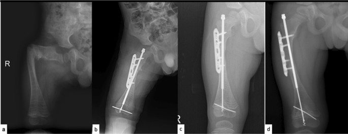 Fixation techniques in lower extremity correction osteotomies and
