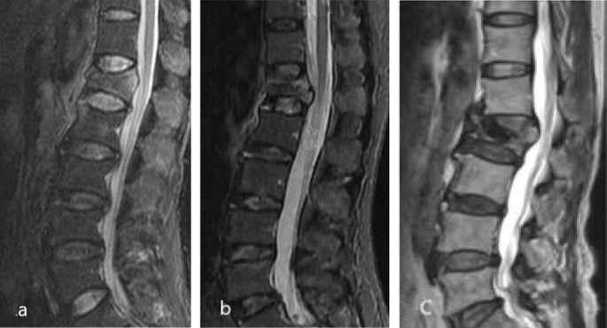 The Radiology Assistant : TLICS Classification of fractures