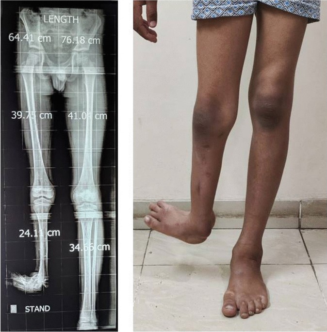 Limb lengthening and reconstruction: Exercises to manage edema and improve  range of motion with a tibial frame