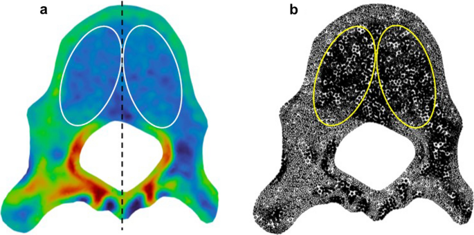 Clinical example of a Boston brace [8,14]. Conventionally a standing 2D