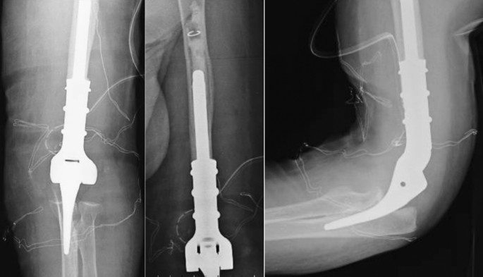 Megaprosthetic replacement in complex distal humerus fractures in elderly  patients: a case series, Journal of Orthopaedic Surgery and Research