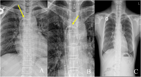 Misplacement of an Internal Jugular Chemo-Port into the Epidural