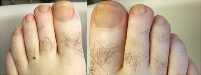 What can fingernails say about your health? - Quora