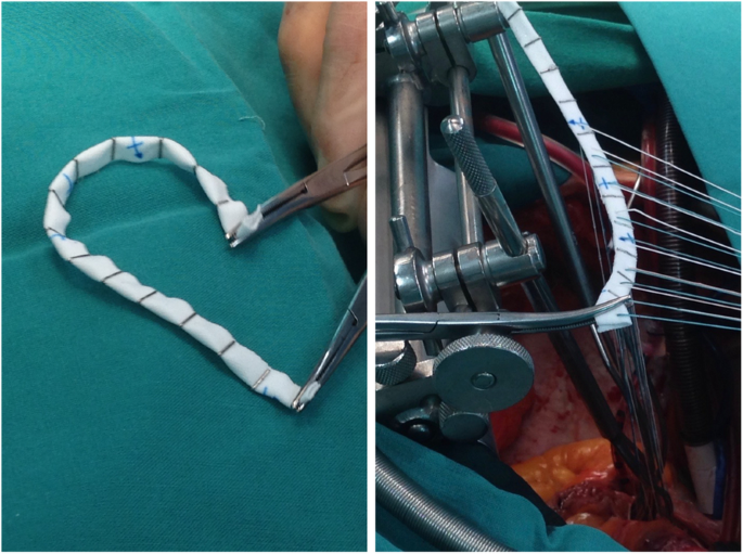 Indian cardiologists transform 'Mitral Valve' care through 'Ring Replacement '