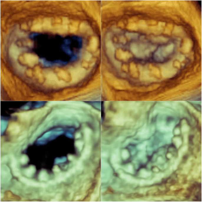 Taming of the Tiger: A Novel Technique to Deal With Mitral Annular  Calcification —A Case Series