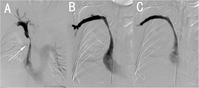 Percutaneous transluminal stenting for superior vena cava syndrome caused  by malignant tumors: a single-center retrospective study | Journal of  Cardiothoracic Surgery | Full Text