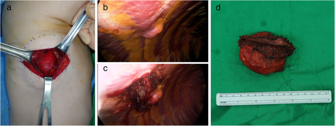 A rare case of chest wall lipoma growing into the pleural cavity: a case  report, Journal of Cardiothoracic Surgery