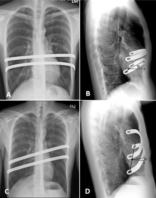 A retrospective study on the impact of bar flipping on the recurrence of  pectus excavatum after the Nuss procedure | Journal of Cardiothoracic  Surgery | Full Text