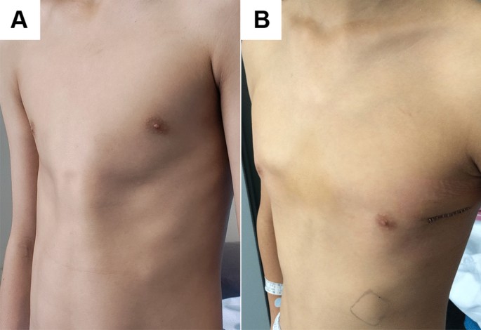 A new minimally invasive technique for correction of pectus carinatum |  Journal of Cardiothoracic Surgery | Full Text