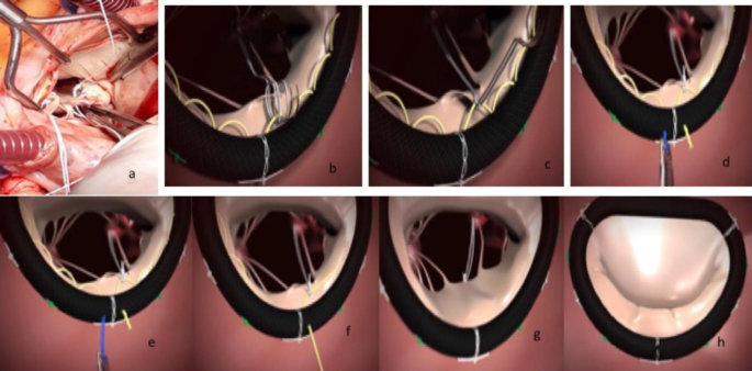 Minimally Invasive Valve Replacements Reduce Healing Time, Scars -  BroadcastMed
