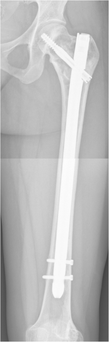 Elastic Nail in Titanium (TEN) and Steel (STEN)