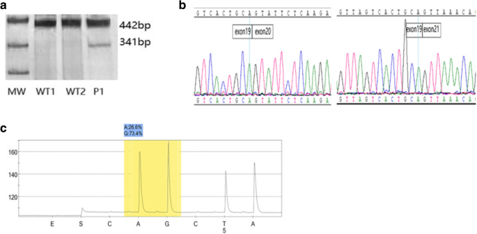 Mosaic CREBBP mutation causes overlapping clinical features of