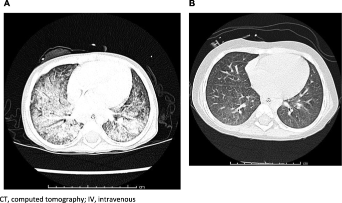 Niemann-Pick B - RS - 5th infusion.