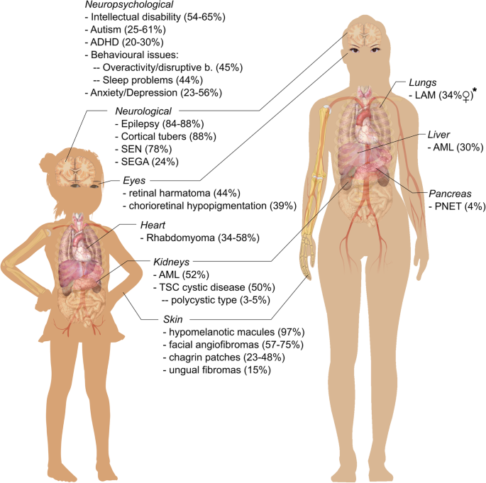 A systematic review on the burden of illness in individuals with tuberous  sclerosis complex (TSC) | Orphanet Journal of Rare Diseases | Full Text