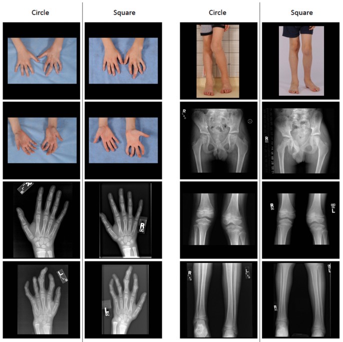 Development of the Clinical Gestalt Assessment: a visual clinical global  impression scale for Proteus syndrome | Orphanet Journal of Rare Diseases |  Full Text