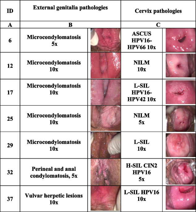 Conventional therapy for genital herpesvirus and remission of HPV-related  lesions: a case series | Infectious Agents and Cancer | Full Text