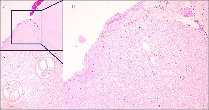 Infection with brainworm (Elaphostrongylus rangiferi) in reindeer