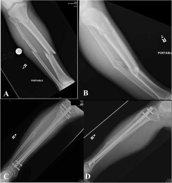 Tibia-Fractures – OrthoPaedia