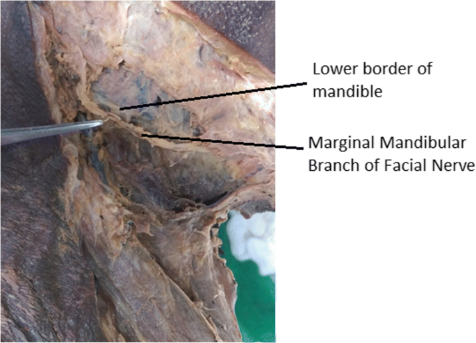 Preserving the marginal mandibular branch of the facial nerve during  submandibular region surgery: a cadaveric safety study, Patient Safety in  Surgery