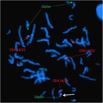 Chromosome 16p13.3 Contiguous Gene Deletion Syndrome including the SLX4,  DNASE1, TRAP1, and CREBBP Genes Presenting as a Relatively Mild Rubinstein- Taybi Syndrome Phenotype: A Case Report of a Saudi Boy. - Document 