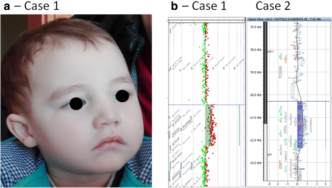 Chromosome 16p13.3 Contiguous Gene Deletion Syndrome including the SLX4,  DNASE1, TRAP1, and CREBBP Genes Presenting as a Relatively Mild Rubinstein- Taybi Syndrome Phenotype: A Case Report of a Saudi Boy. - Document 