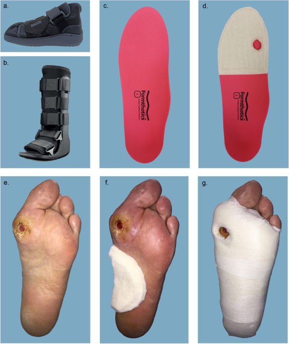 Offloading effects of a removable cast walker with and without modification  for diabetes-related foot ulceration: a plantar pressure study | Journal of  Foot and Ankle Research | Full Text