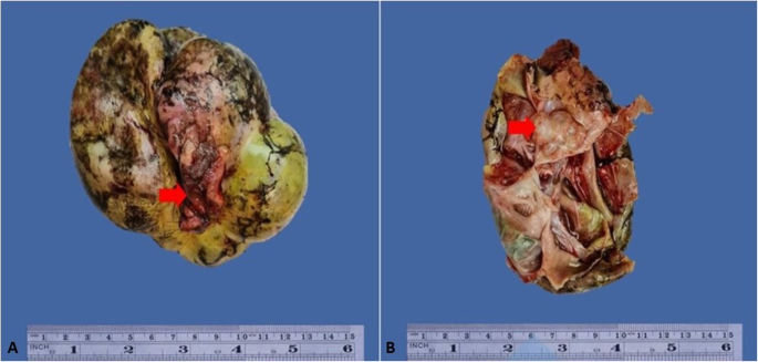 Clinicopathological Characteristics and Prognosis of 91 Patients with  Seromucinous and Mucinous Borderline Ovarian Tumors: a Comparative Study