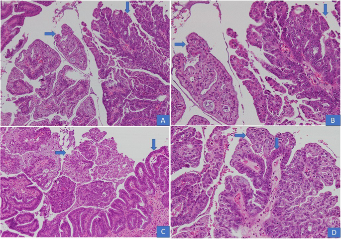 Clinicopathological Characteristics and Prognosis of 91 Patients with  Seromucinous and Mucinous Borderline Ovarian Tumors: a Comparative Study