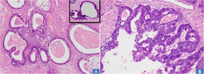 a Picture of an ovarian seromucinous borderline tumour. The