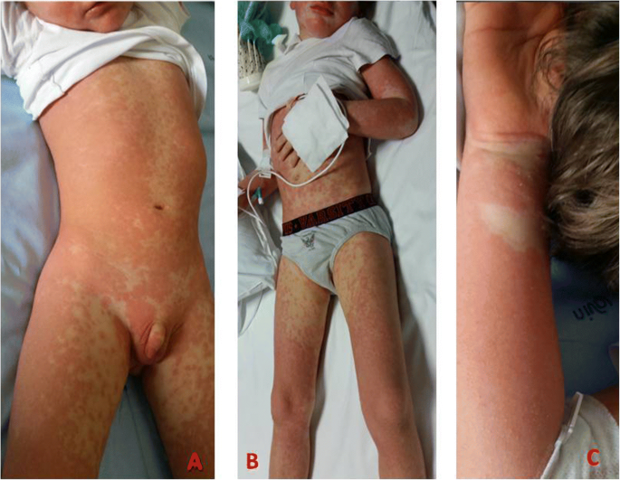 Drug reaction with eosinophilia and systemic symptoms (DRESS) syndrome in two young children: the importance of an early diagnosis | Italian Journal of Pediatrics | Springer Nature Link Drug reaction with eosinophilia and systemic symptoms (DRESS) syndrome in two young children: the importance of an early diagnosis | Italian Journal of Pediatrics | Springer Nature Link