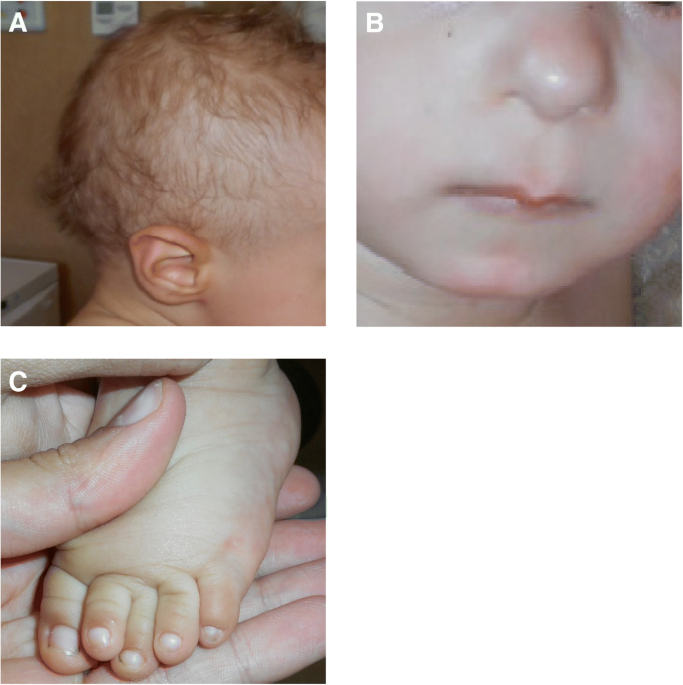 An early diagnosis of trichorhinophalangeal syndrome type 1: a case report  and a review of literature | Italian Journal of Pediatrics | Full Text