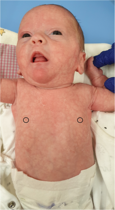 Severe haemophilia a in a preterm girl with turner syndrome - a case report  from the prenatal period to early infancy (part I) | Italian Journal of  Pediatrics | Full Text