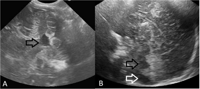 Hyperinsulinism in an individual with an EP300 variant of