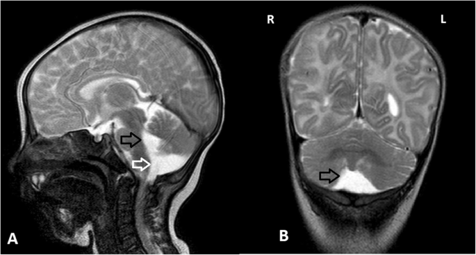 Hyperinsulinism in an individual with an EP300 variant of