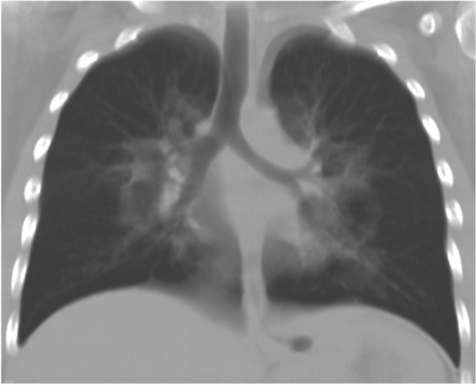 E-cigarette or Vaping product use Associated Lung Injury (EVALI) in a 15  year old female patient  case report | Italian Journal of Pediatrics |  Springer Nature Link