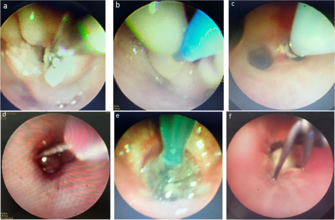 Mourning  Bronchoscopy International