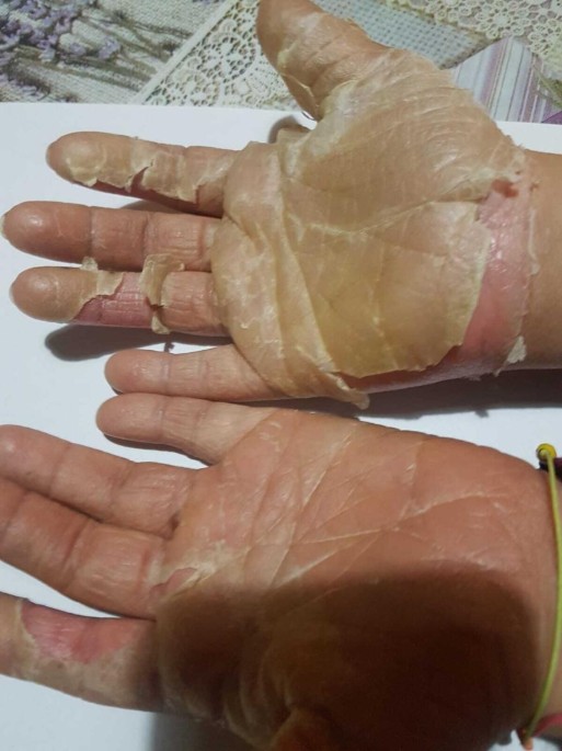 Scabies-induced hyperkeratosis of the hands