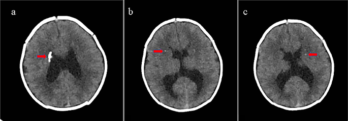 l carnitine deficiency radiology Carnitine palmitoyltransferase II (CPT II) deficiency responsible for  refractory cardiac arrhythmias, acute multiorgan failure and early fatal  outcome | Italian Journal of Pediatrics