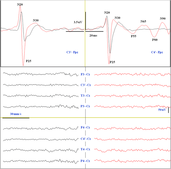 Automated cortical auditory evoked potentials threshold estimation in  neonates☆