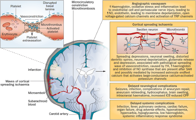 Subarachnoid Hemorrhage (SAH): Symptoms & Treatment