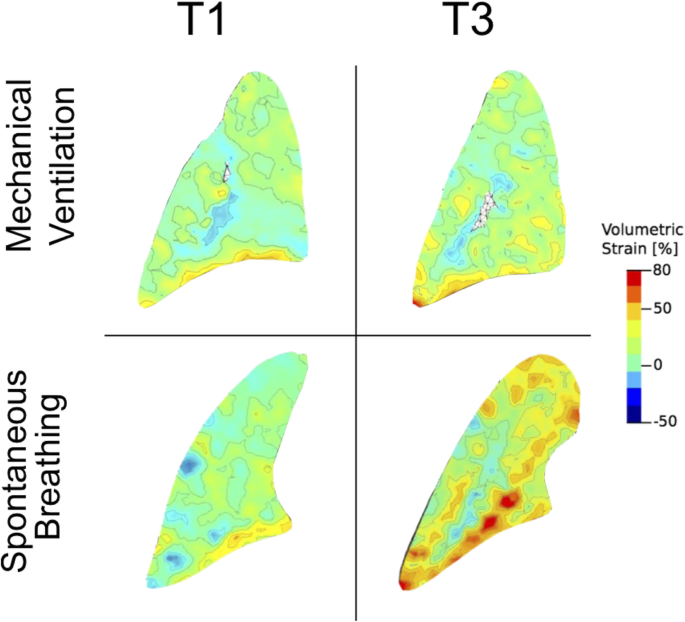 A physiological approach to understand the role of respiratory effort in  the progression of lung injury in SARS-CoV-2 infection | Critical Care |  Full Text