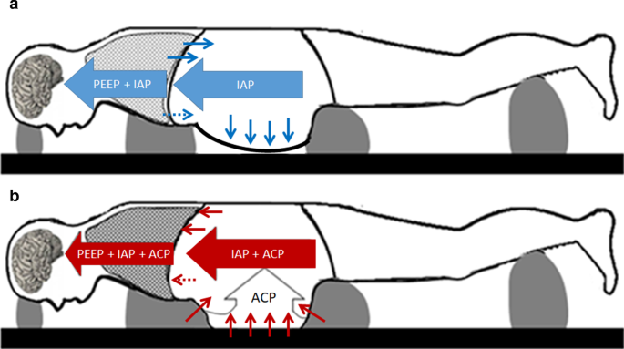 Summary of effects of different body positions on IAP compared to the